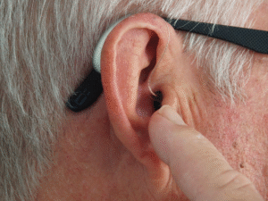 Links Between Loss of Hearing and Alzheimer's Disease